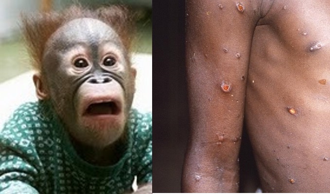Kenali gejala dan penularan penyakit langka cacar monyet, (Foto: Istimewa)