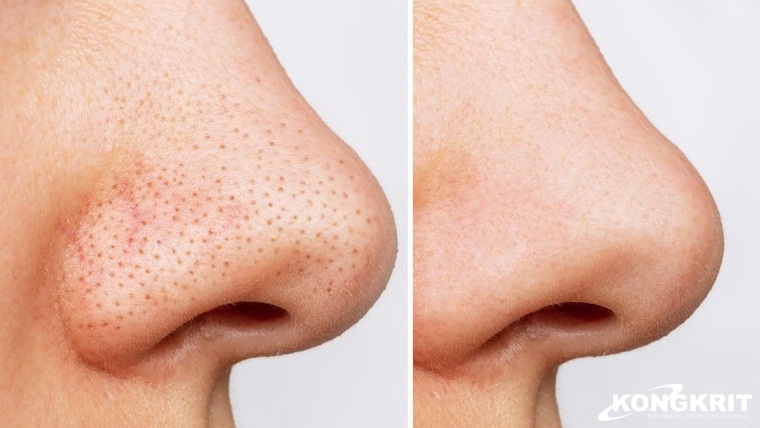 Menghilangkan Komedo dengan Mudah, Tips dan Trik untuk Kulit Bebas Masalah. (Foto : Dok. Istimewa)