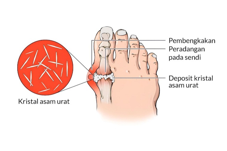 Rahasia Asam Urat Tinggi yang Jarang Diketahui -- Apakah Anda Terancam Tophus dan Kerusakan Sendi? (Foto : Dok. Istimewa)