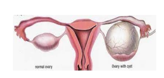 Foto Kenali Kista Ovarium Penyakit yang Menyerang Organ Rproduksi Wanita